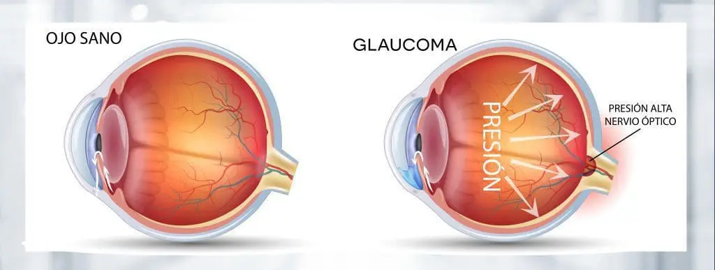 Glaucoma