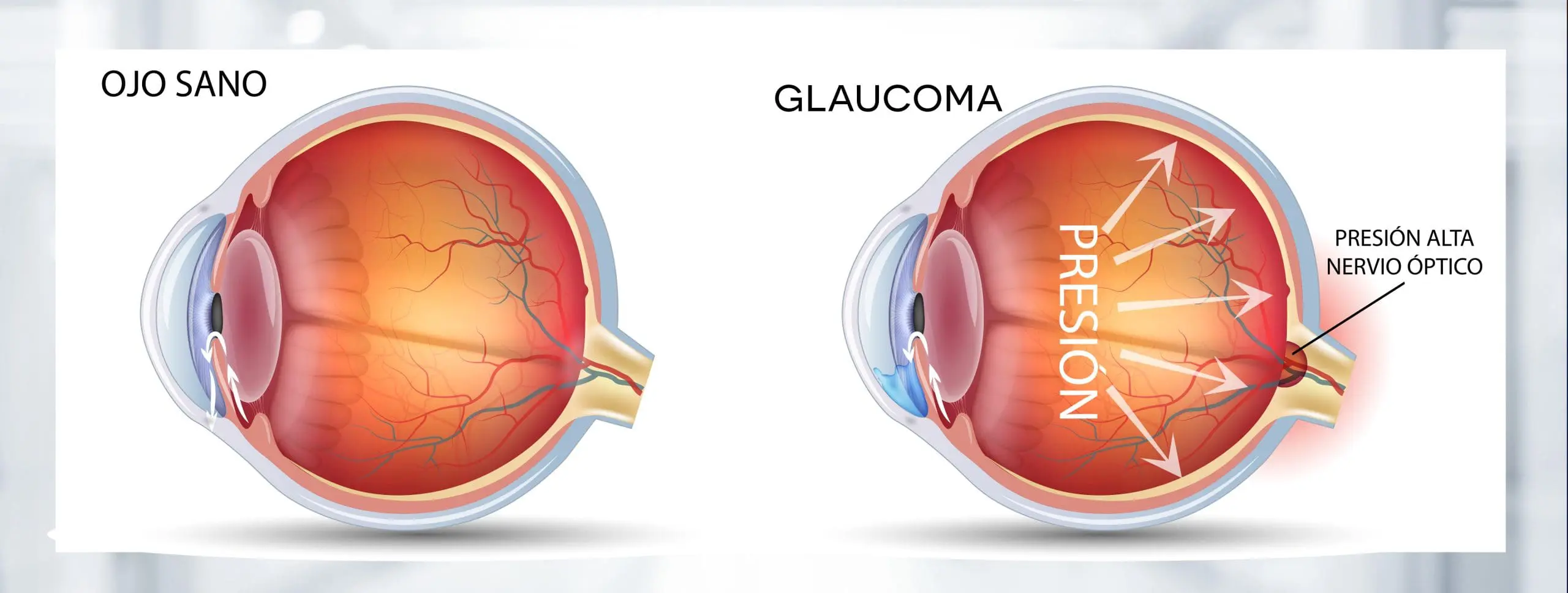 Glaucoma