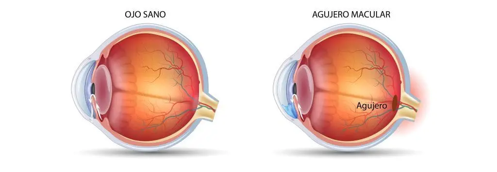 agujero macular omiq